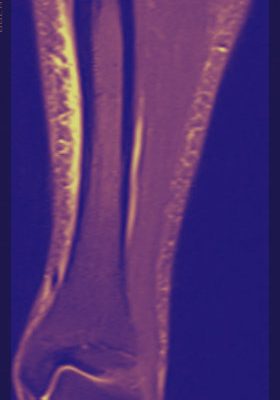 xray of shin splints